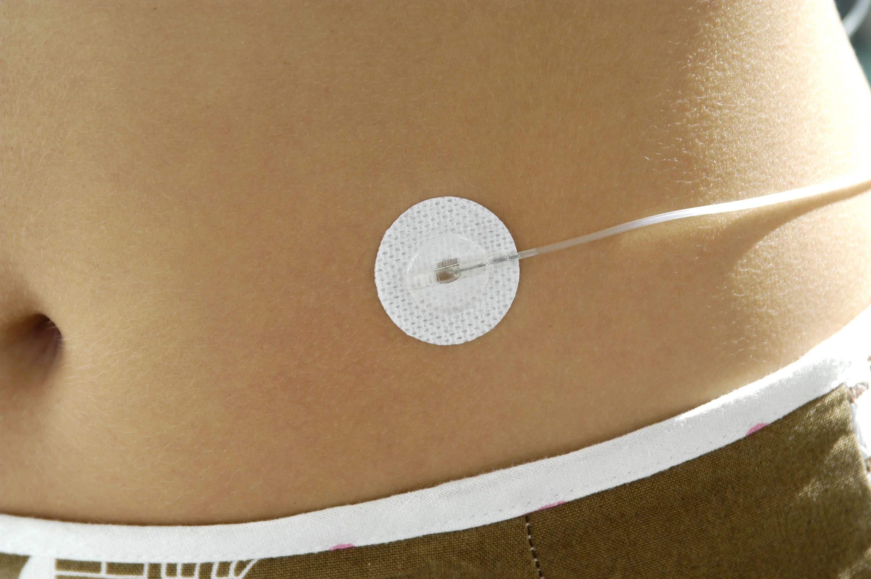 Set di infusione Neria sul corpo